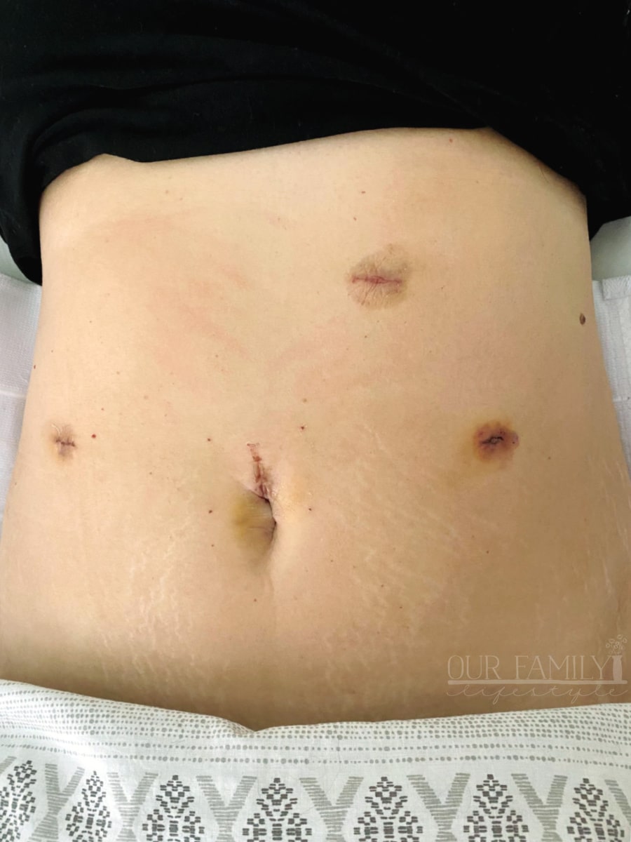 post hysterectomy abdominal cuts